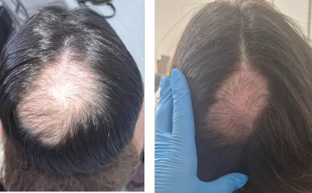 Couro cabeludo em tratamento capilar estético na La Vie Clinic