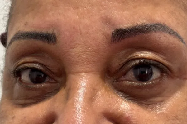 Logo após o retoque com nanobrows: sobrancelhas redesenhadas com fios definidos
