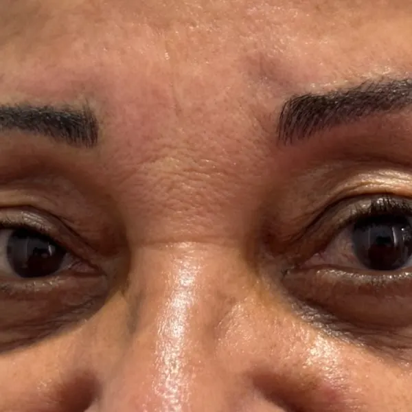 Logo após o retoque com nanobrows: sobrancelhas redesenhadas com fios definidos